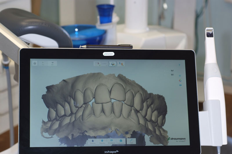 Ett digitalt avtryck av tänder.