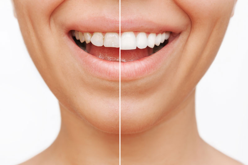 Före och efterbild av tandblekning